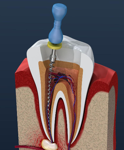 Why do I need a crown after root canal treatment?