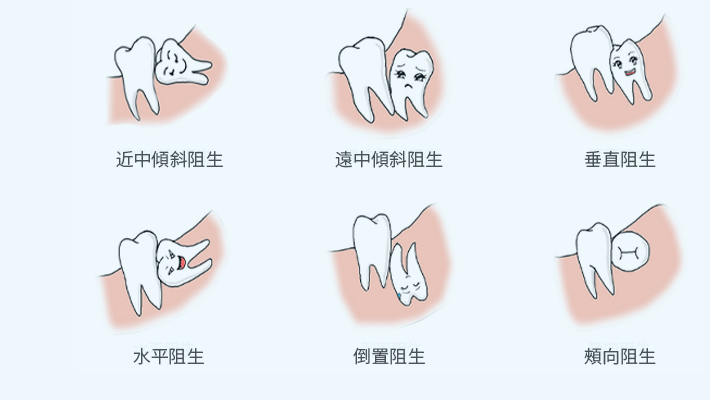 Shenzhen Tooth Extraction Recommendation