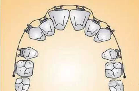 20 Misconceptions About Teeth Straightening