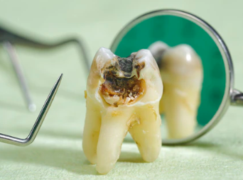 Why are there black substances in the gaps between teeth?