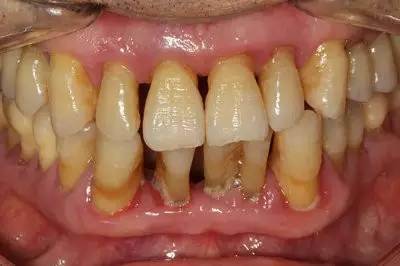 "Unexpectedly, the 'Chronic Killer' of Teeth—It's Periodontal Disease!"
