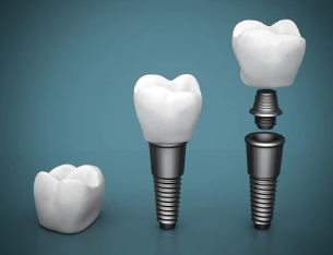 What body and oral examinations should be done before implant surgery