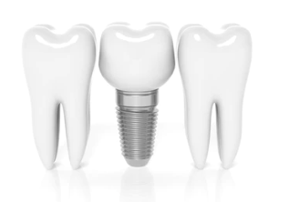 What are the advantages and characteristics of dental implants?