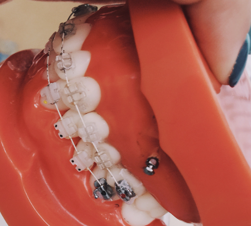 Which orthodontic method is suitable for adults?