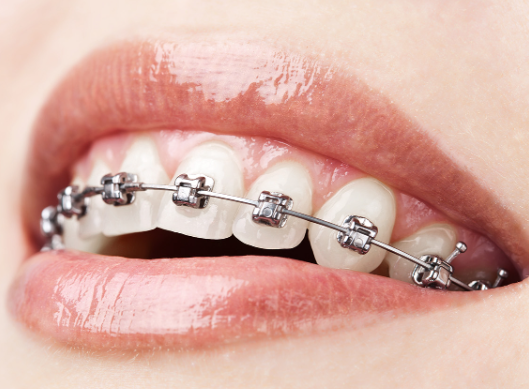 Ten Misunderstandings of Children's Orthodontics 2023 Edition