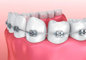 Can adults straighten their teeth?