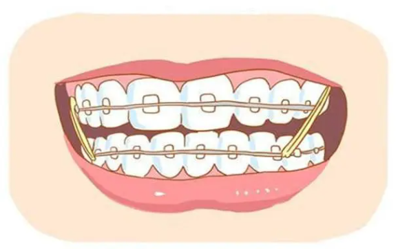 Orthodontics five finishing effects