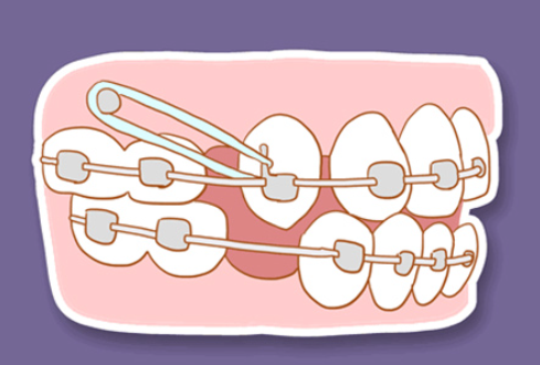 Is it effective to treat sparse teeth in adults?