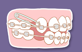 Adults worry about orthodontics: I don't want to become a "steel tooth girl"