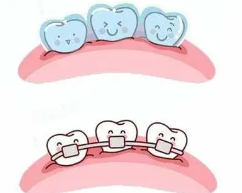 The difference between adult orthodontics and children's orthodontics