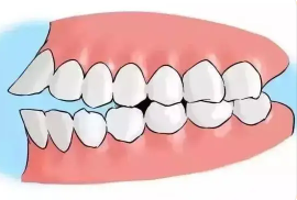 The characteristics of adult orthodontics and the problems that should be paid attention to