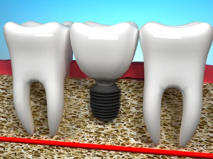 The difference between self-ligating and non-self-ligating orthodontics