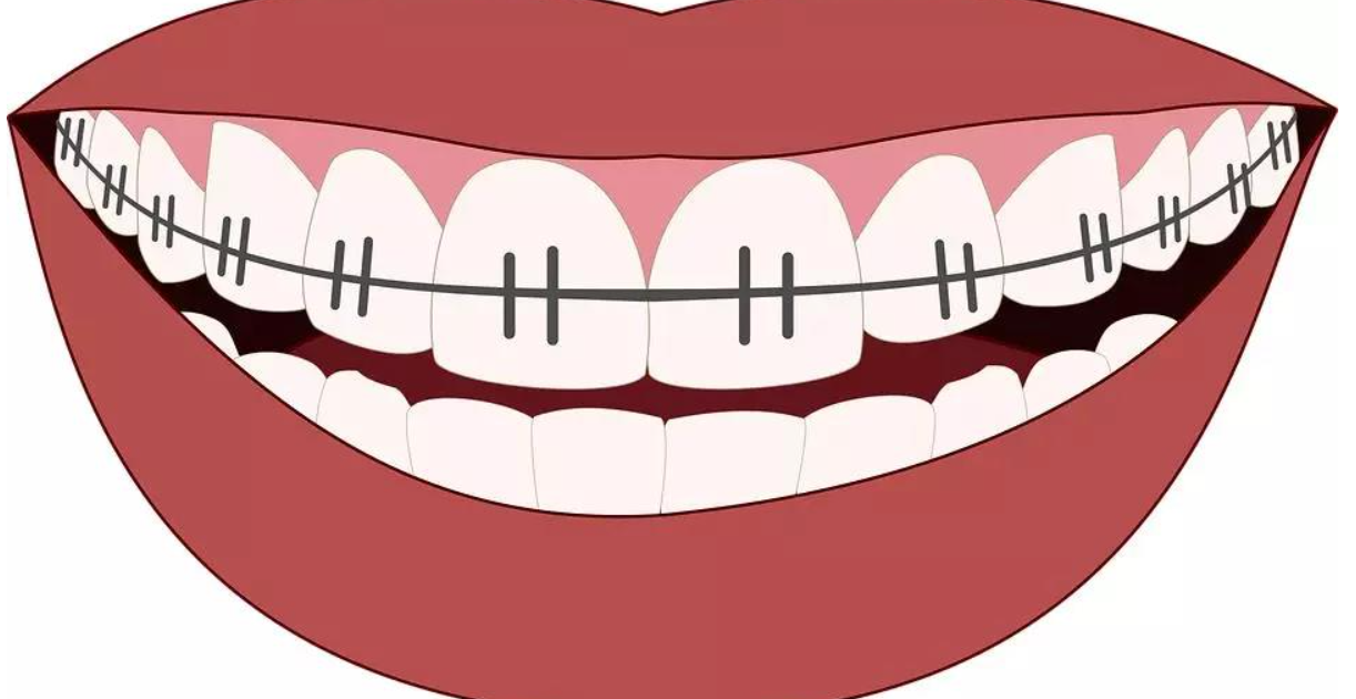 Adult Orthodontics Mistakes in Orthodontics Part 1