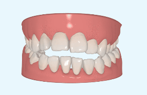 Orthodontic concerns for adults: Can I still have orthodontics at my age?