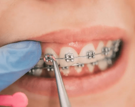 Introduction to Rapid Orthodontics for Adults