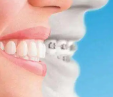 Adult orthodontics be careful! ! !