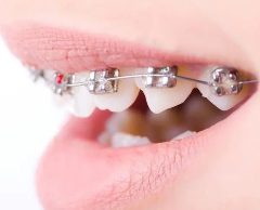 After adult orthodontics, do I have to wear a retainer for life?
