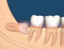 What age is best to extract wisdom teeth