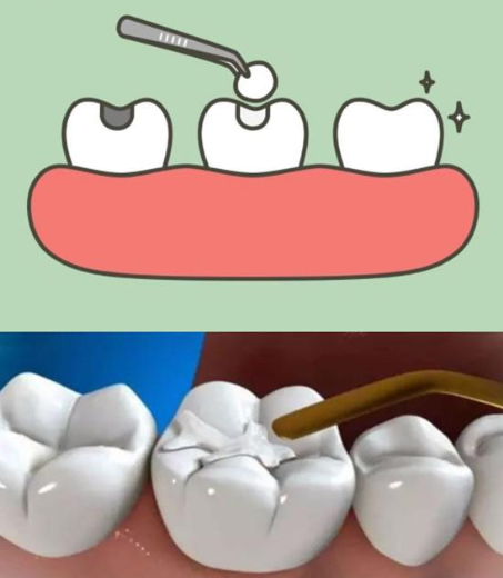 Is filling 1000 expensive? Before filling the teeth, it only cost more than 300 yuan. Why is there such a big difference in price?