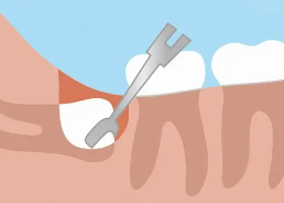 What age is best to extract wisdom teeth