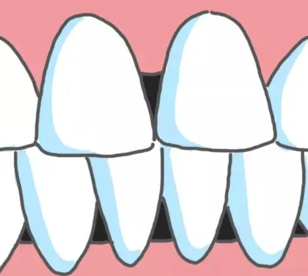 What is the cause of the "black triangle" of teeth?