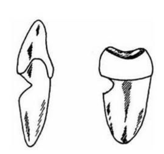 What is a wedge defect?