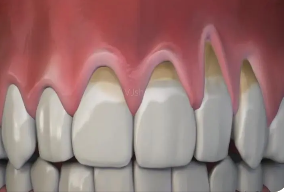 4 dangers of porcelain teeth, you must be careful!