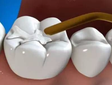 What does filling a tooth mean?