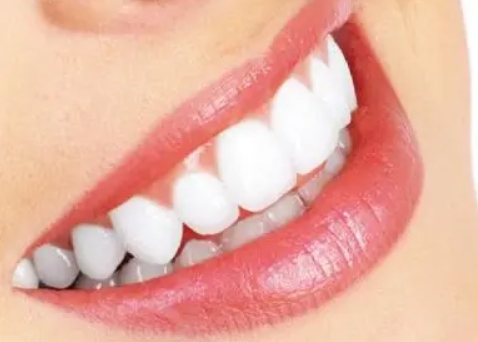 Teeth Whitening Misconceptions Reminder