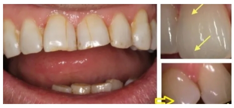 It’s so scary. There are cracks in the teeth. Pictures attached.