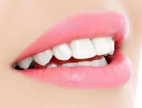 5 myths about teeth whitening that may not be true enough!