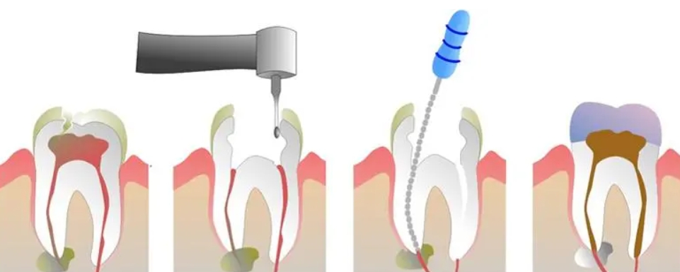 What does root canal treatment do?