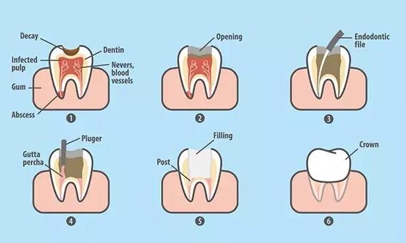 Why is root canal treatment so expensive?