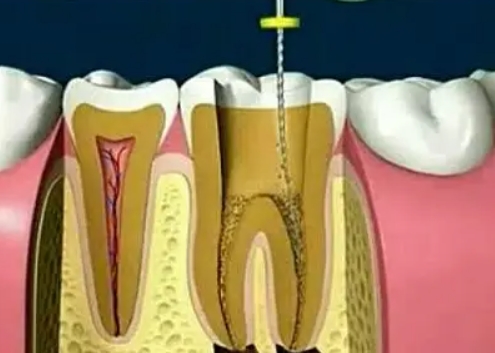 What are the indications for root canal treatment?