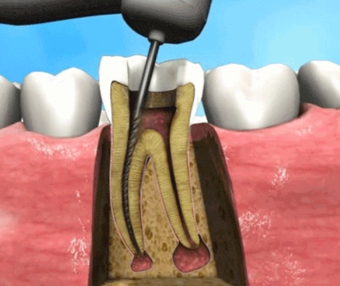 What situations require root canal treatment?