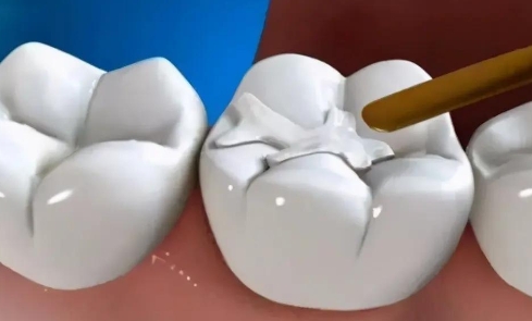 Advantages and Disadvantages of Resin Dental Fillings
