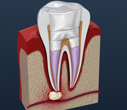 What are the consequences of not filling your teeth in time?