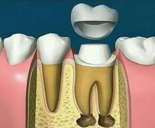 What is root canal treatment? Is root canal treatment safe?