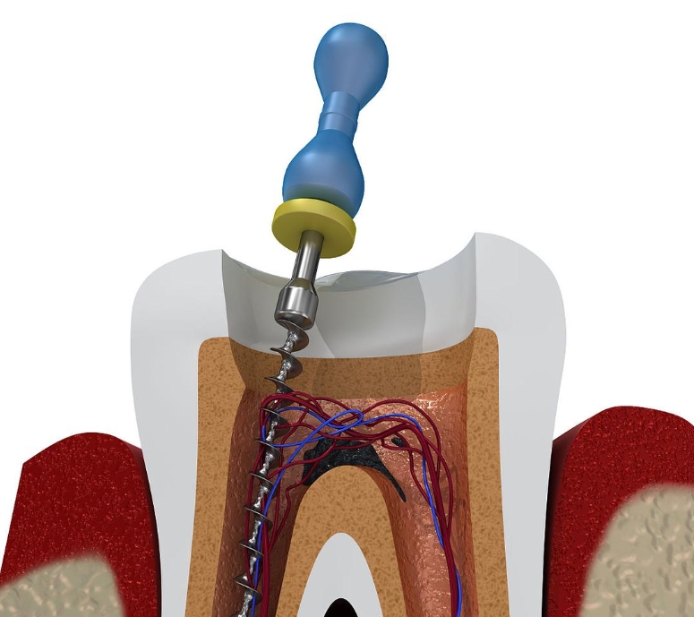Advantages and Disadvantages of Root Canal Treatment