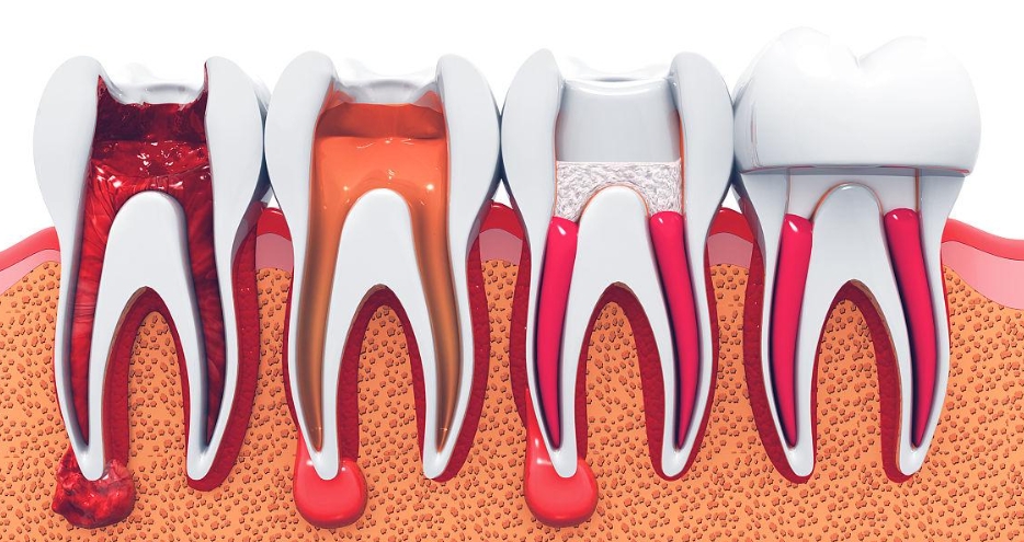 What should I do if root canal treatment fails? What is periapical surgery?