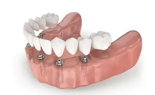 What are the advantages of half-mouth removable dental implants in mainland China? How much does a half-mouth dental implant cost in Shenzhen?