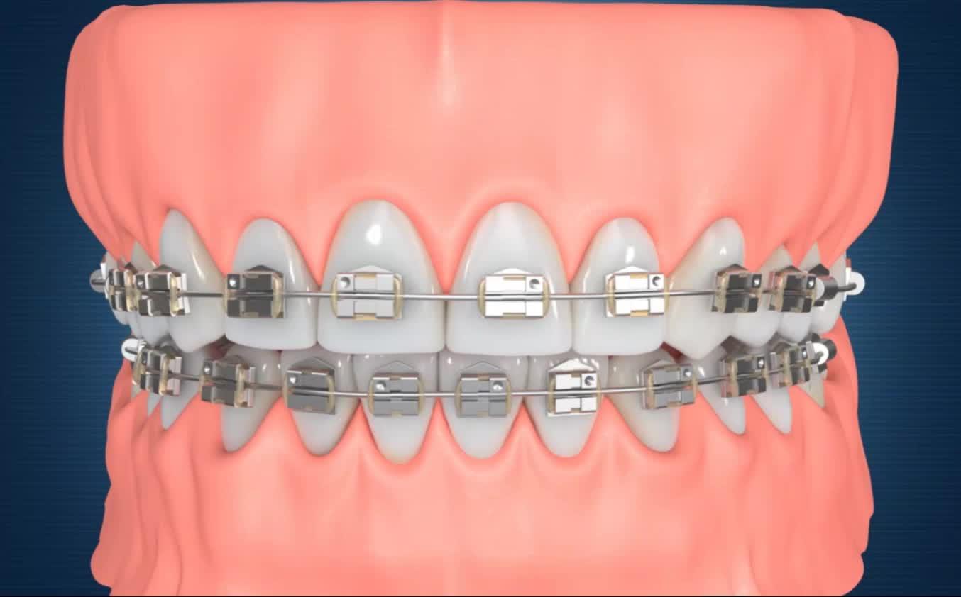 Macau hoop tooth price 2024: Factors affecting the price of hoop teeth