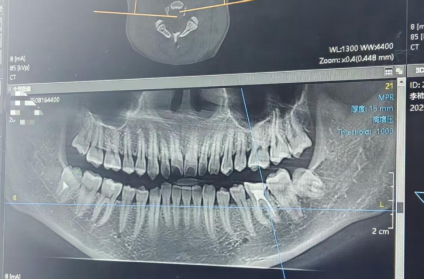 Wisdom Tooth Extraction? Not Scary at All!