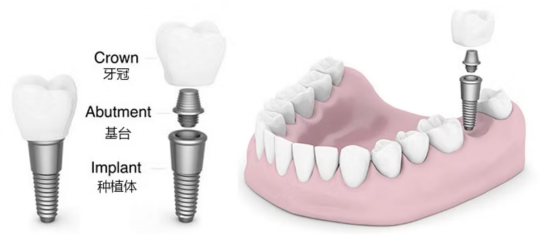 Dental Implants: What You Need to Know