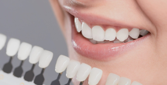 Macau Full-Porcelain Veneers What’s the Typical Cost
