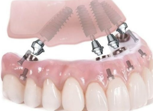 All-on-4 Full Mouth Reconstruction Costs and Related Information in Macau