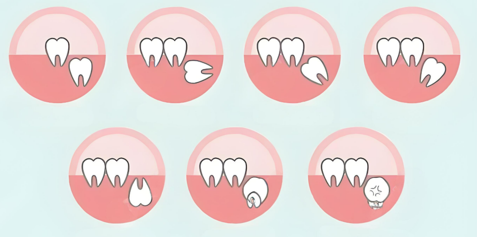 Wisdom Tooth Removal in Zhuhai｜Why Is Removing Impacted Wisdom Teeth So Expensive