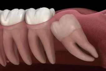 Tooth Extraction Isn’t Scary