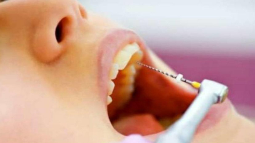 Zhuhai Secondary Root Canal Treatment Prices and Dentist Recommendations