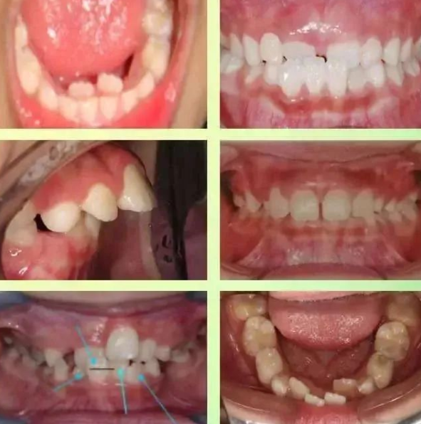 What is Early Childhood Orthodontics?